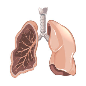 Fibrose pulmonar